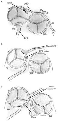 Surgery for Anomalous Aortic Origin of Coronary Arteries: Technical Safeguards and Pitfalls